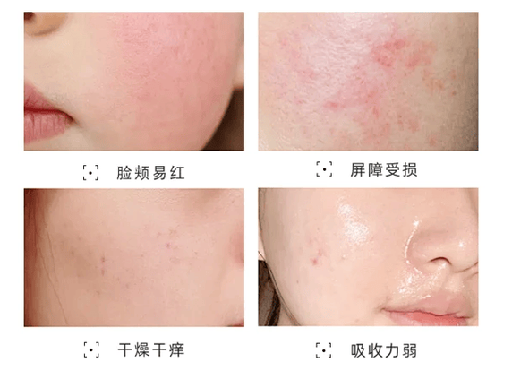 皮肤油脂旺盛怎么控?