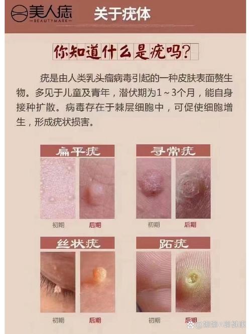 皮肤疣是何原因造成的?
