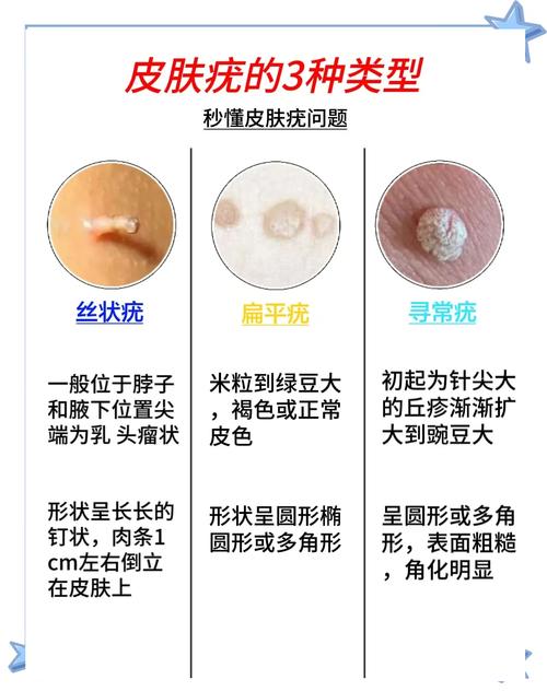 皮肤疣是何原因造成的?