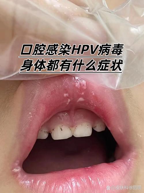 HPV病毒会感染口腔吗?