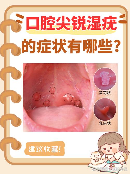 HPV病毒会感染口腔吗?