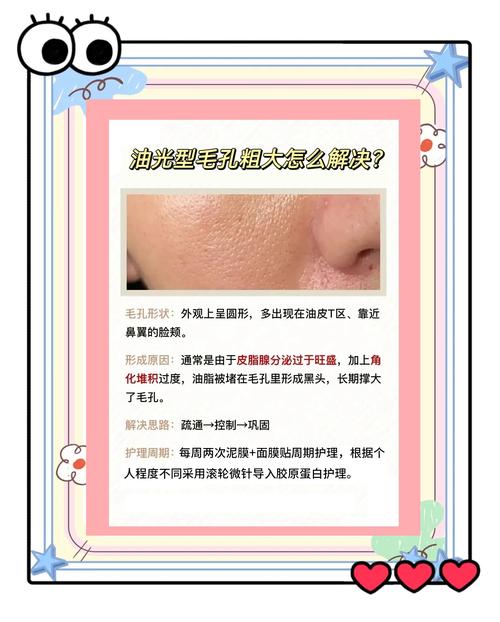 皮肤出油毛孔粗大,怎么有效改善?