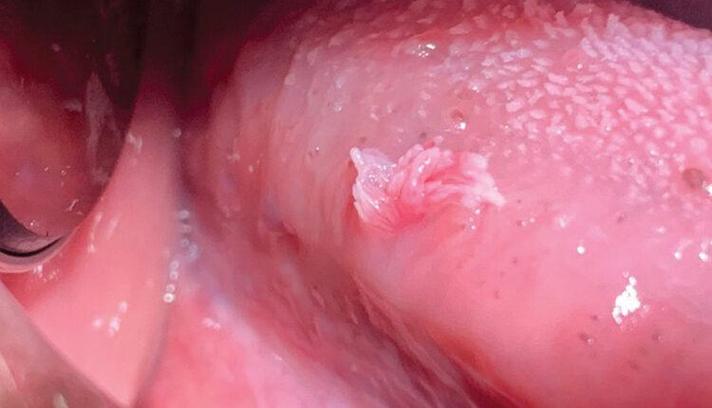 口腔感染hpv16有哪些典型症状?