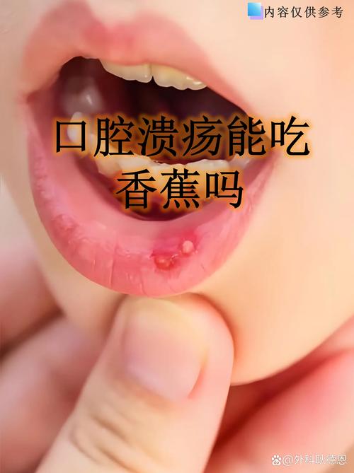 吃什么水果能快速治口腔溃疡?