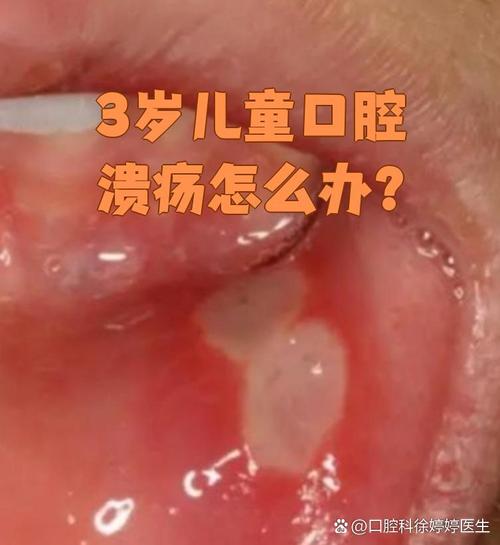 三岁宝宝口腔溃疡,怎么办?