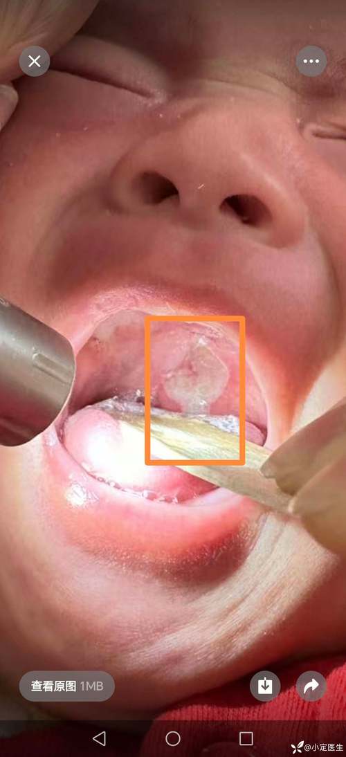 三岁宝宝口腔溃疡,怎么办?