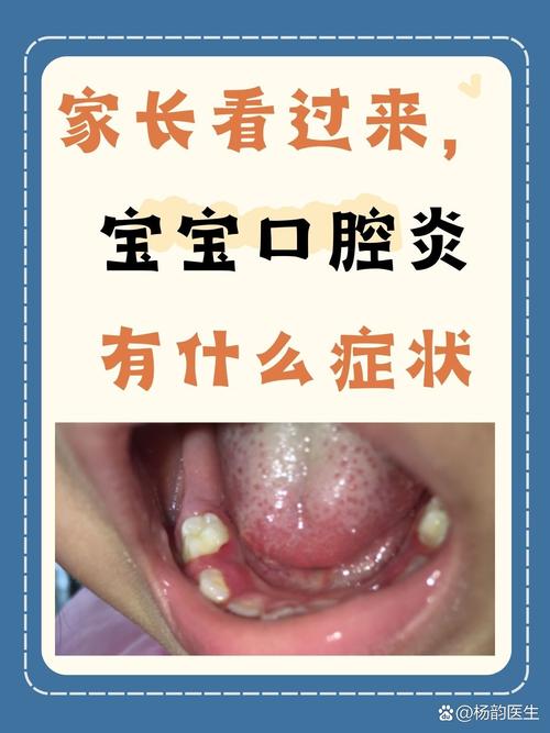 三岁宝宝口腔溃疡,怎么办?
