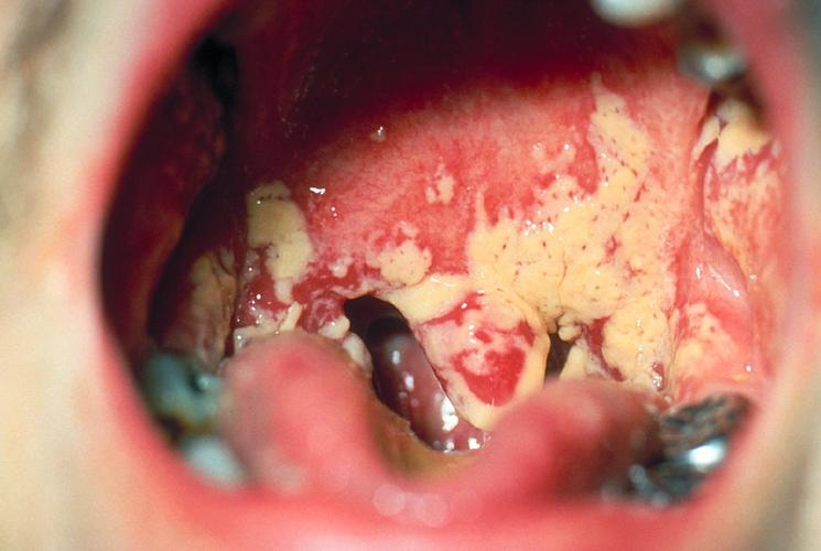 白色念珠菌口腔感染有哪些典型症状?
