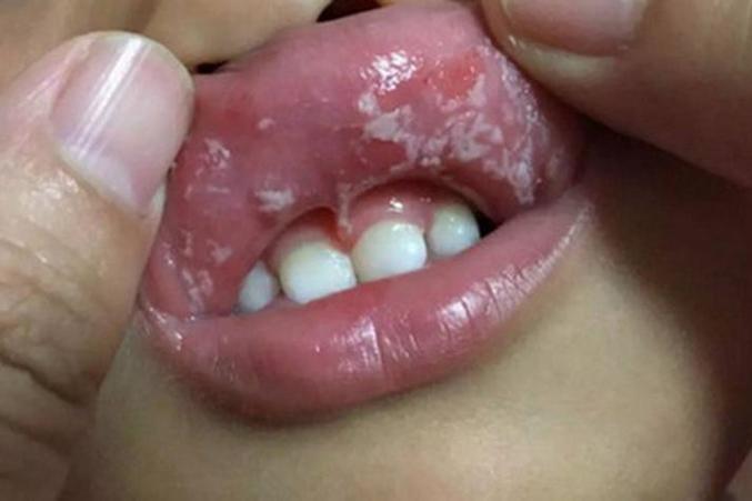 白色念珠菌口腔感染有哪些典型症状?