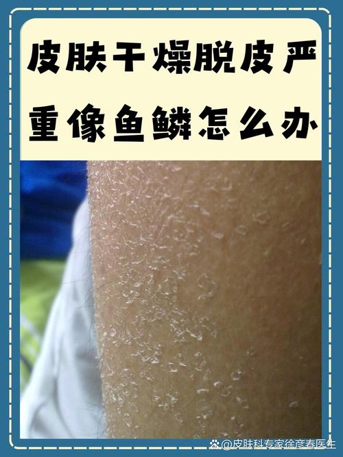 皮肤干燥脱皮,是缺水还是生病了?
