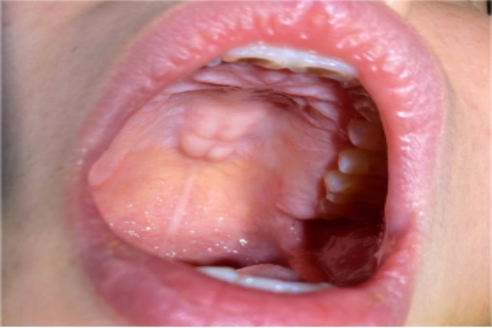 口腔内壁凸起线是病吗?需警惕吗?