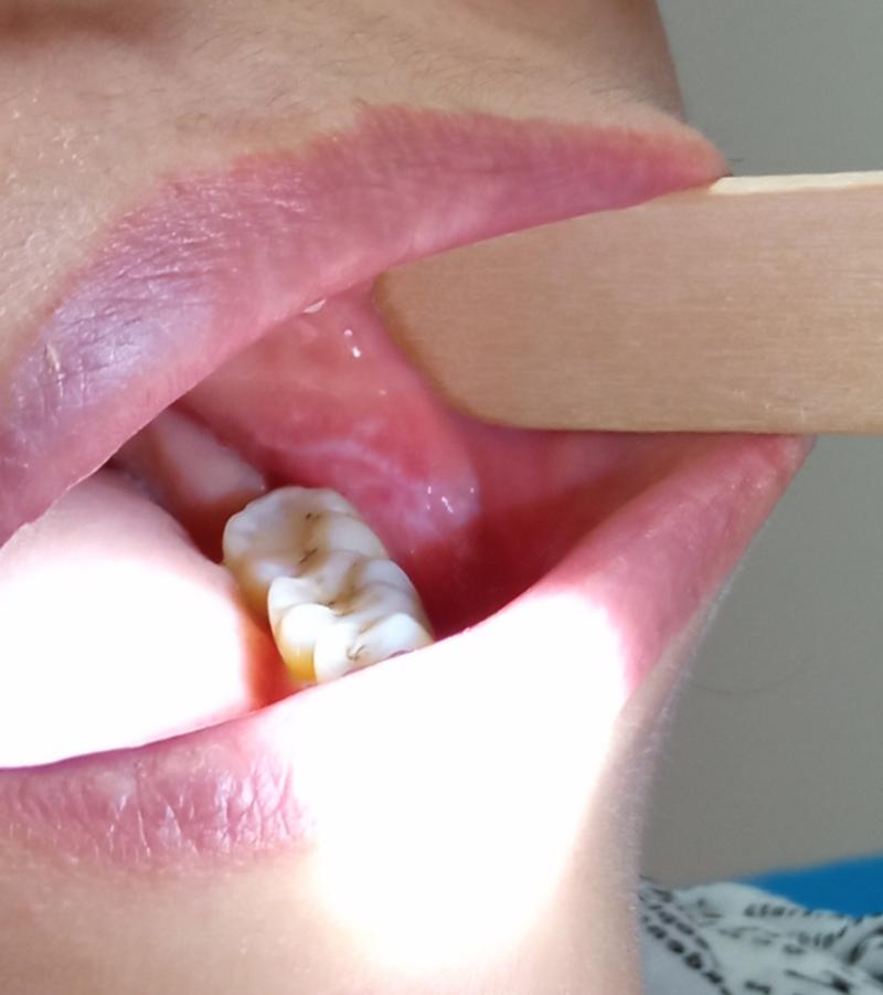 口腔内壁凸起线是病吗?需警惕吗?