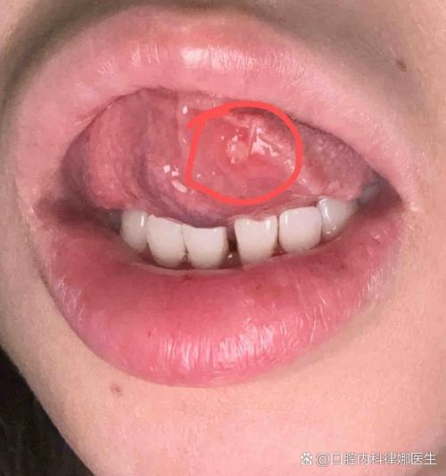 舌下溃疡难愈怎么办?