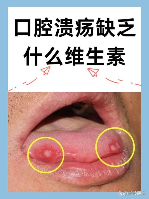 口腔溃疡真是缺维生素导致的吗?