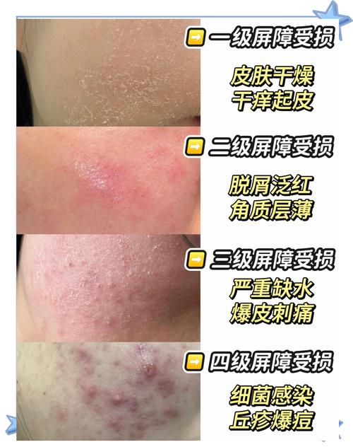 皮肤干燥起皮,如何快速补水修复?