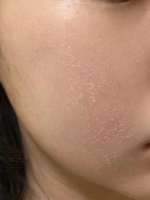 皮肤干燥起皮,如何快速补水修复?