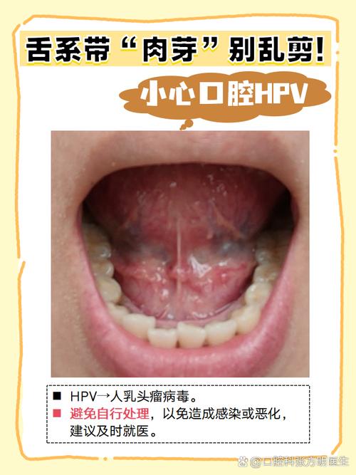 口腔会感染HPV病毒吗?