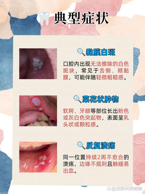 口腔会感染HPV病毒吗?