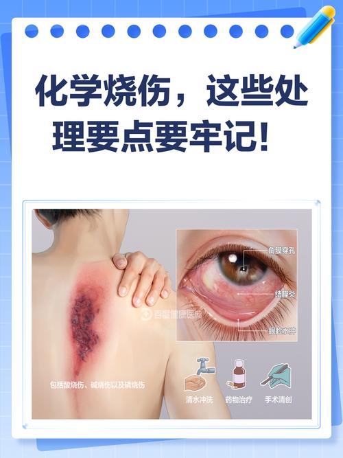 硫酸溅到皮肤上如何处理