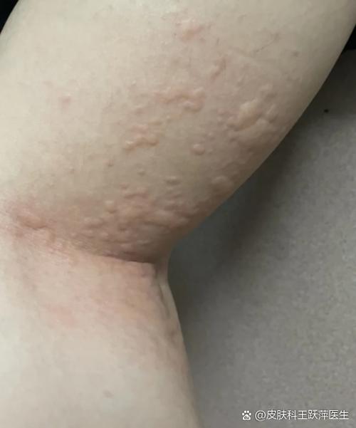 皮肤莫名起疙瘩痒,是过敏还是其他问题?