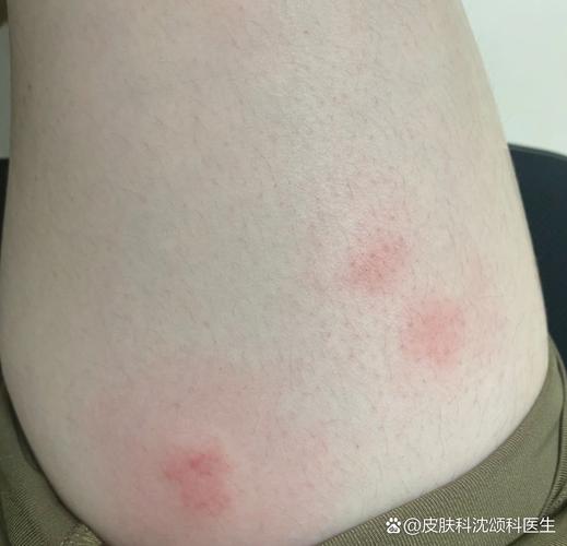 皮肤莫名起疙瘩痒,是过敏还是其他问题?