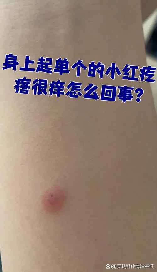 皮肤莫名起疙瘩痒,是过敏还是其他问题?