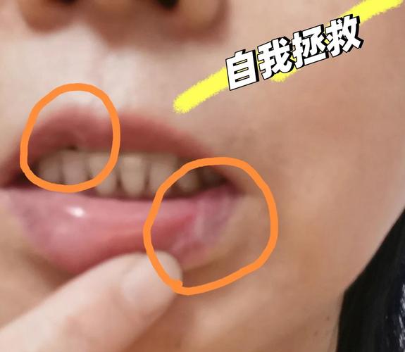 口腔扁平苔藓可以治愈吗