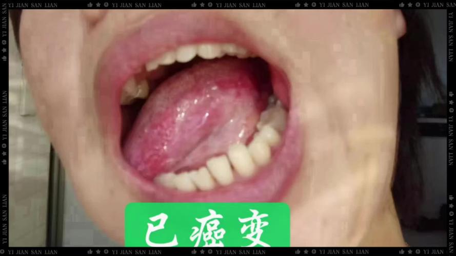 口腔扁平苔藓可以治愈吗