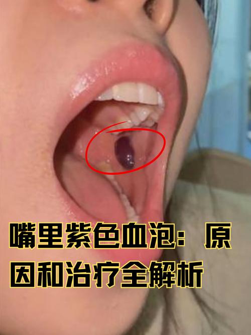 口腔血泡是何原因引起的?