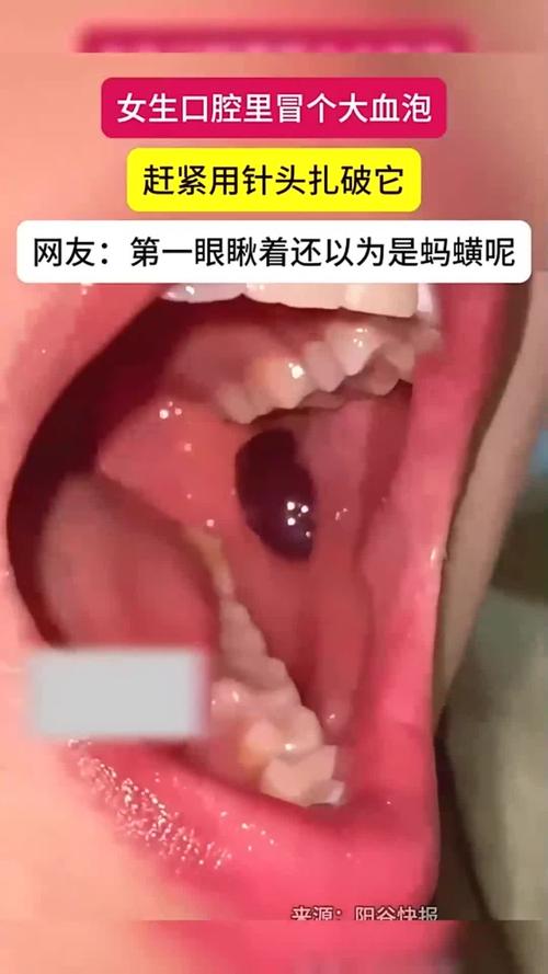 口腔血泡是何原因引起的?