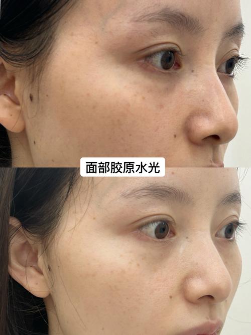 打水光针对皮肤到底有没有伤害?