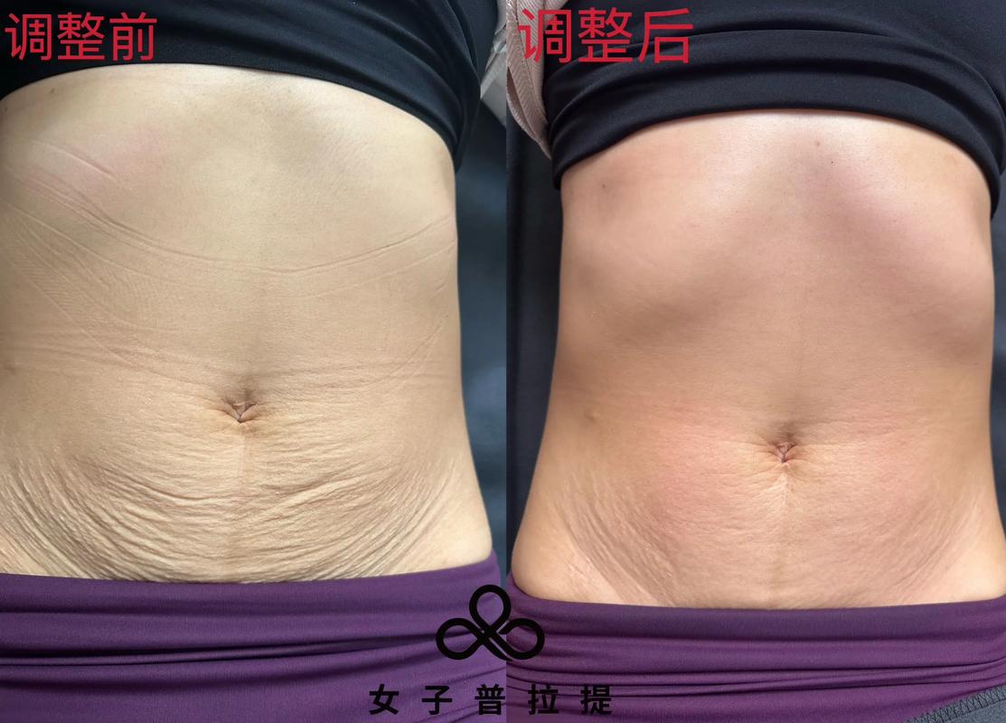 瘦后皮肤松弛,怎么紧致不反弹?