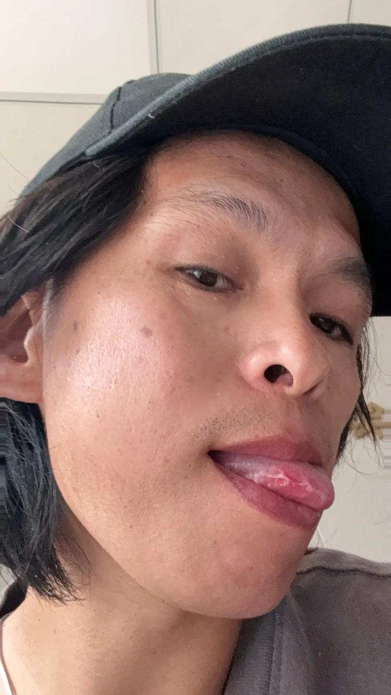 口腔溃疡会长在舌头上吗?