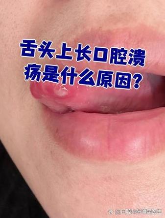 口腔溃疡会长在舌头上吗?