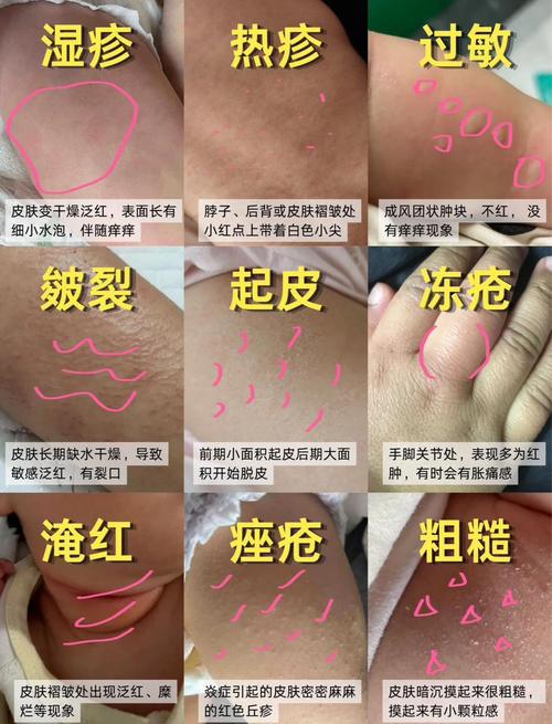 冬天皮肤干痒怎么办?