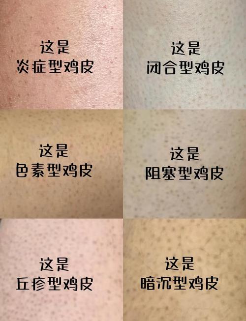 鸡皮肤成因,遗传还是其他因素在作祟?