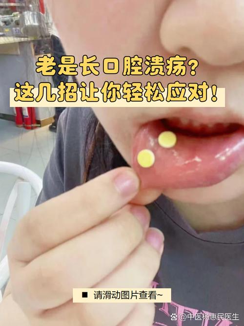 口腔溃疡是缺哪种维生素?