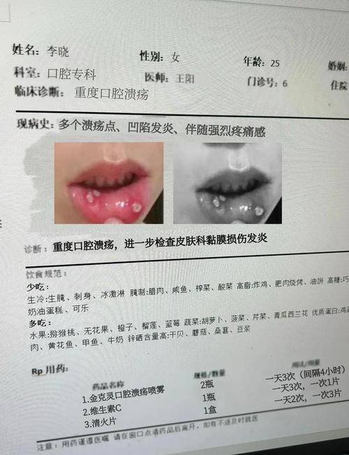 口腔溃疡该补维C还是维B?