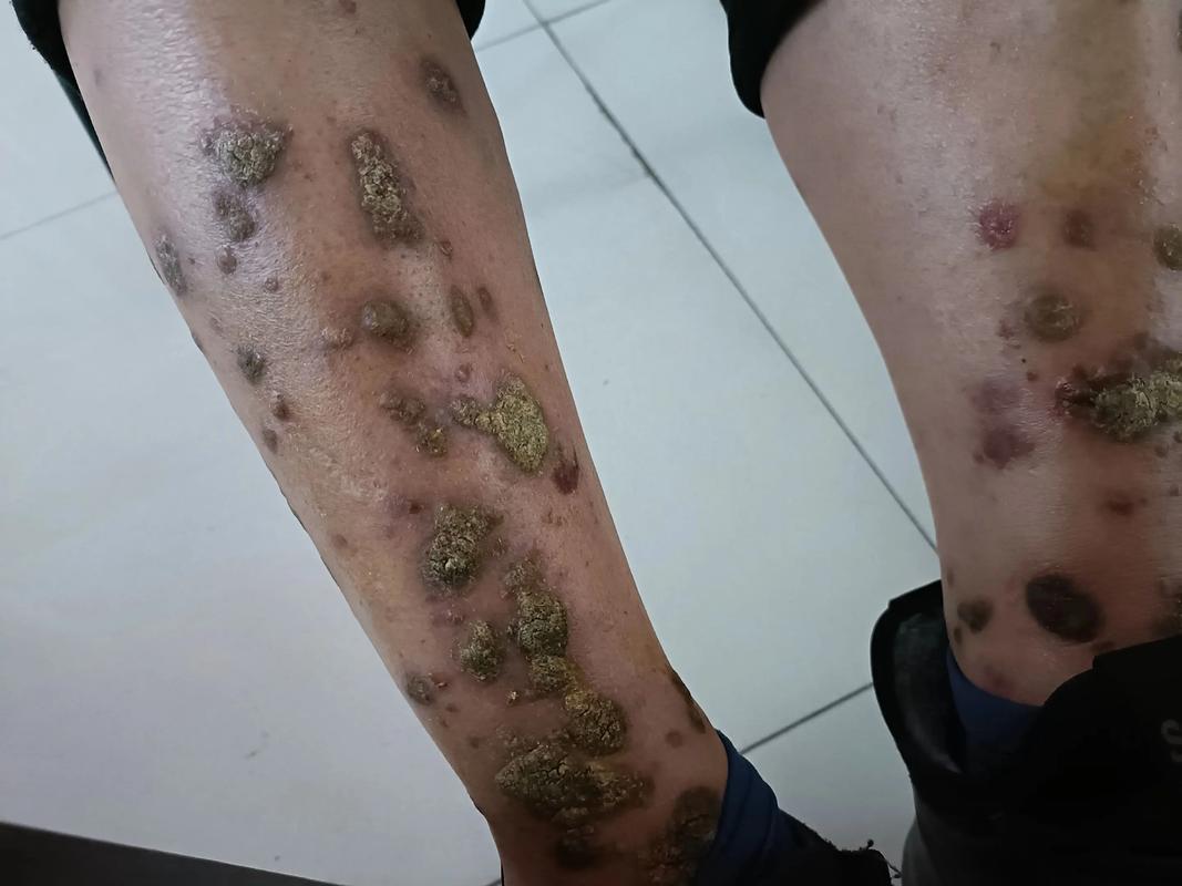 放疗后皮肤溃烂如何快速恢复?