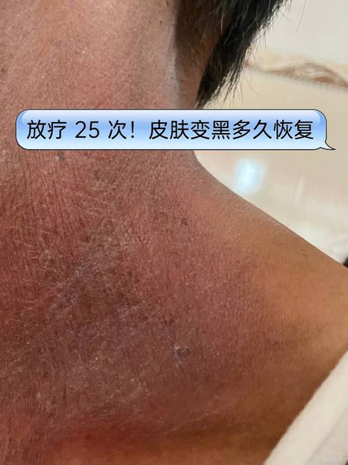 放疗后皮肤溃烂如何快速恢复?