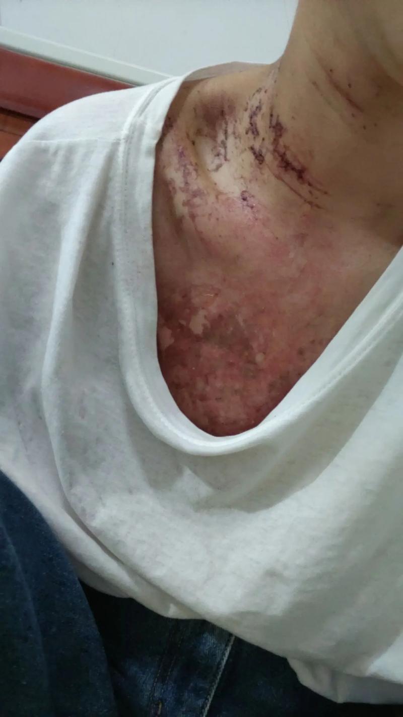 放疗后皮肤溃烂如何快速恢复?