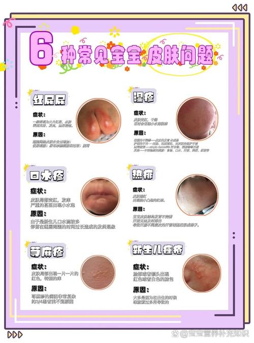 新生儿皮肤红是何原因?