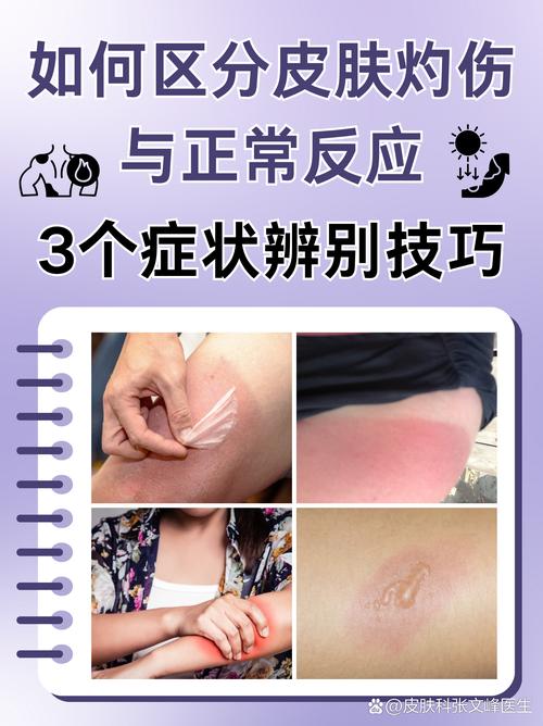 皮肤灼烧感外表正常,是何原因?