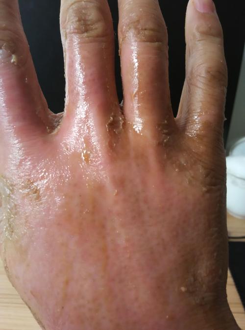 皮肤灼烧感外表正常,是何原因?