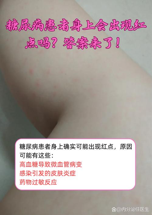 血糖高为何会引发皮肤瘙痒?