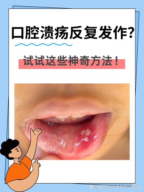 口腔溃疡该挂口腔科吗?