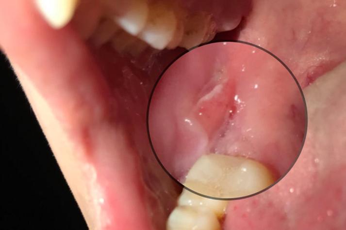 北京口腔医院口腔溃疡怎么治?