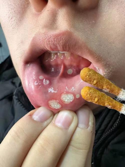北京口腔医院口腔溃疡怎么治?