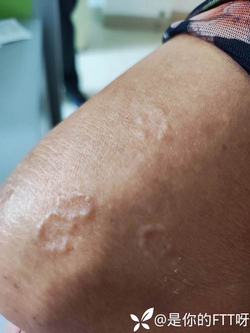 环状肉芽肿是种什么皮肤病?