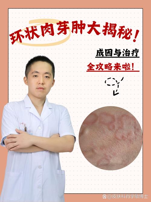 环状肉芽肿是种什么皮肤病?